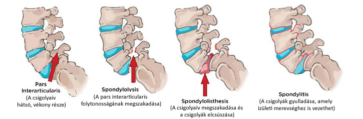 Csigolya elcsúszásának folymata és lehetséges következménye