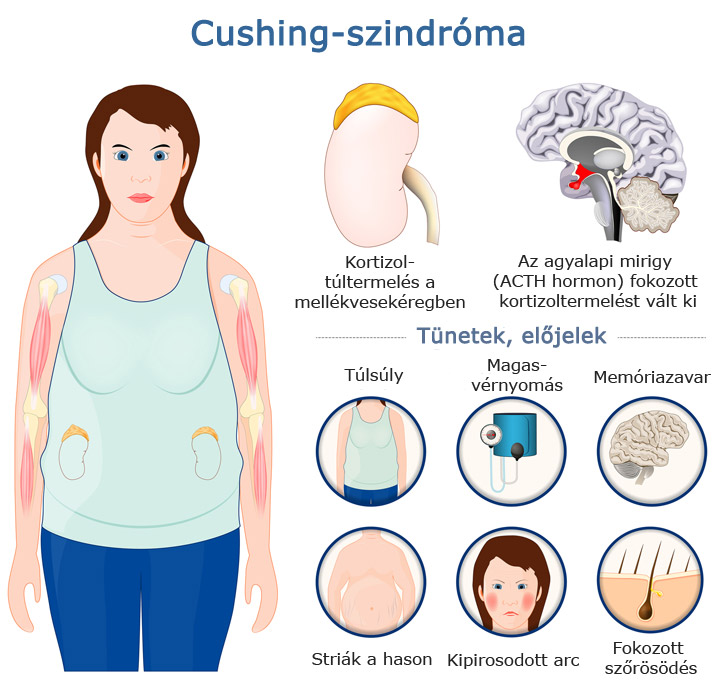 Cushing-szindróma ábra infografika