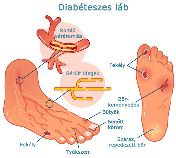 Diabéteszes láb tünetei, kialakulása - feliratos ábra