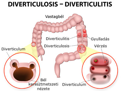 Diverticulosis és diverticulitis