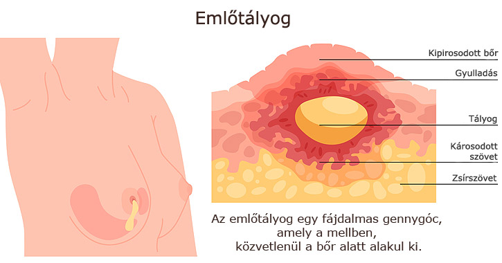 Emlőtályog ábra