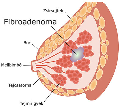 Emlő fibroadenoma ábra