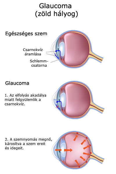 Glauzoma (zöld hályog) kialakulása