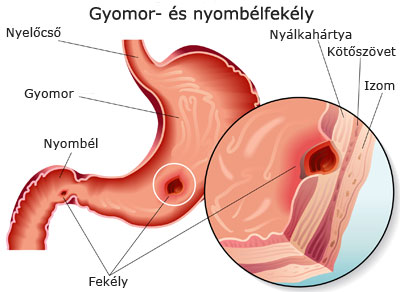 Gyomorfekély-nyombélfekély anatómiai ábra