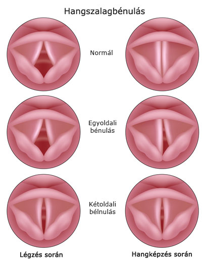 Egyoldali és kétoldali hangszalagbénulás