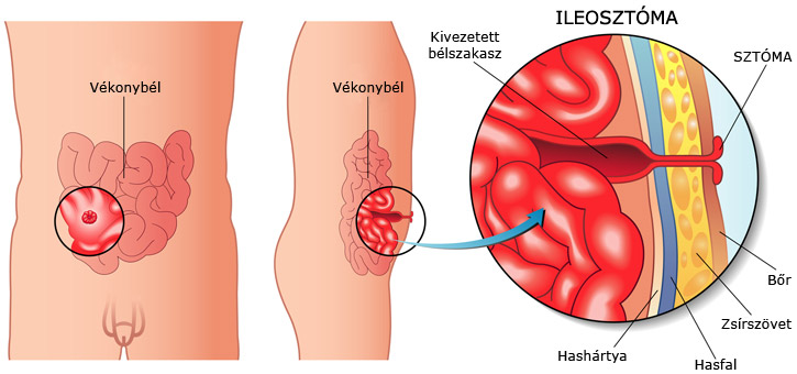 Ileosztóma ábra