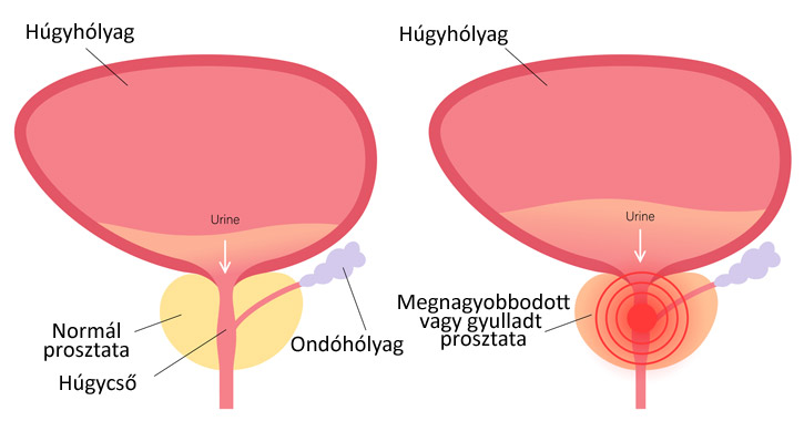 Prosztataproblémák és inkontinencia