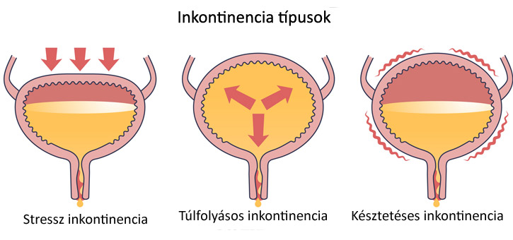 Inkontinencia típusok