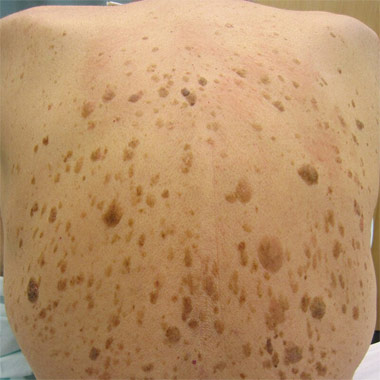 Keratosis seborrhoica, időskori hámszemölcs