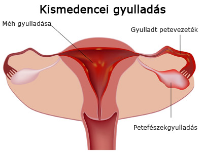 Kismedencei gyulladás, petefészek-gyulladás