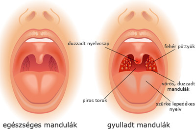 Garatmandula gyulladás