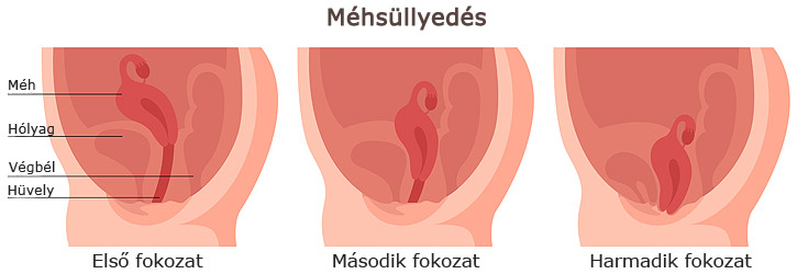 A méhsüllyedés és fokozatai