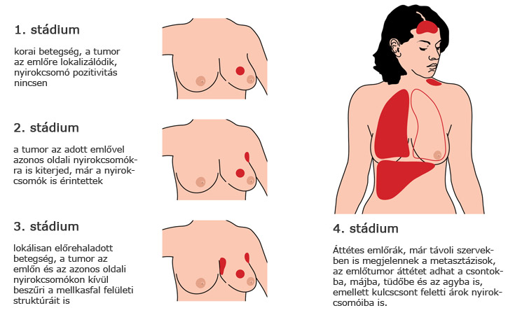 A mellrák stádiumai, áttétek ábra