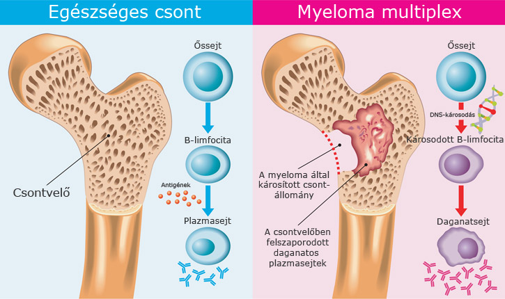 Myeloma multiplex