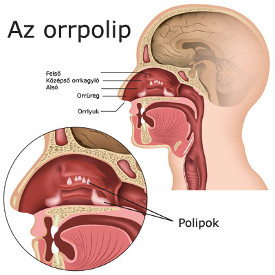 Orrpolipok helye az orrkagylóban - ábra