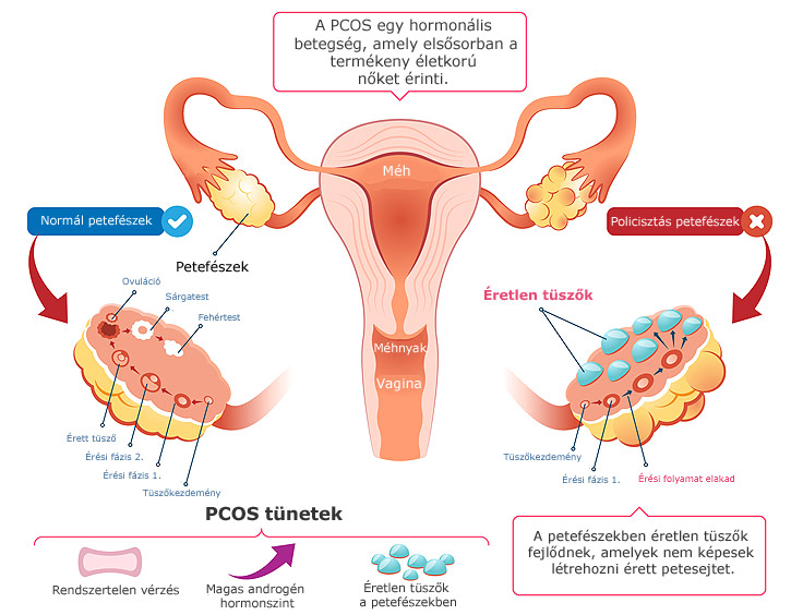 PCOS grafika