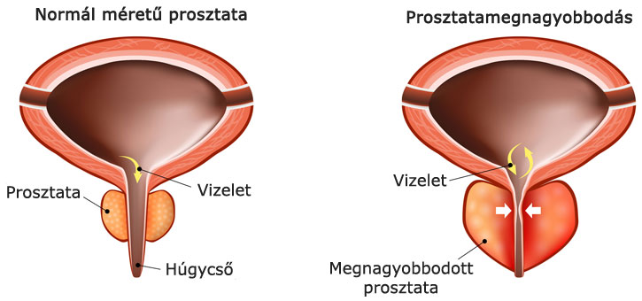 Normál méretű prosztata és prosztatamegnagyobbodás vizeletelakadással