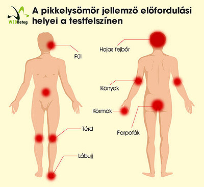 Pikkelysömör előfordulási helyei a testen