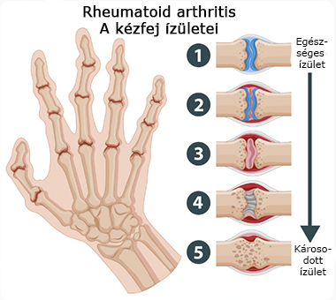 Ábra: rheumatoid arthritis a kézfej ízületekben