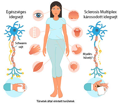 Sclerosis multiplex grafika