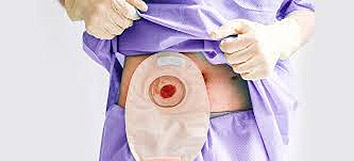 Sztómazsák felhelyezve