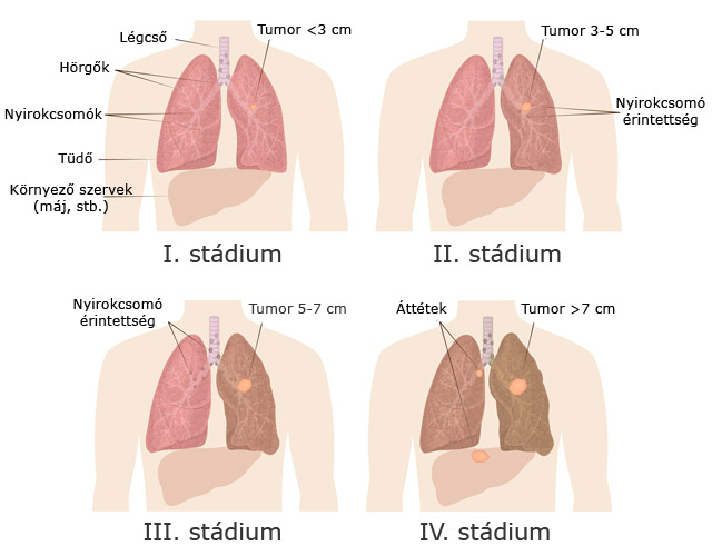 A tüdőrák stádiumai 1-4.