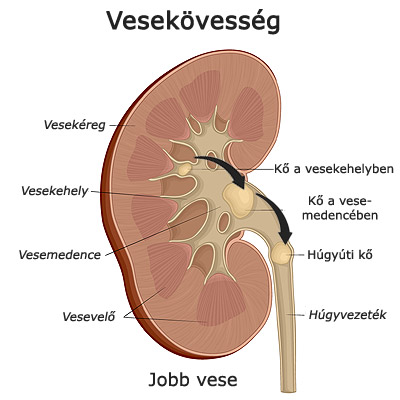 Vesekövek a vesében