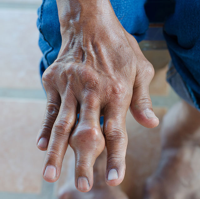 hogyan kell kezelni ha a kéz ízületei fájnak reumás artritisz térd tünetei