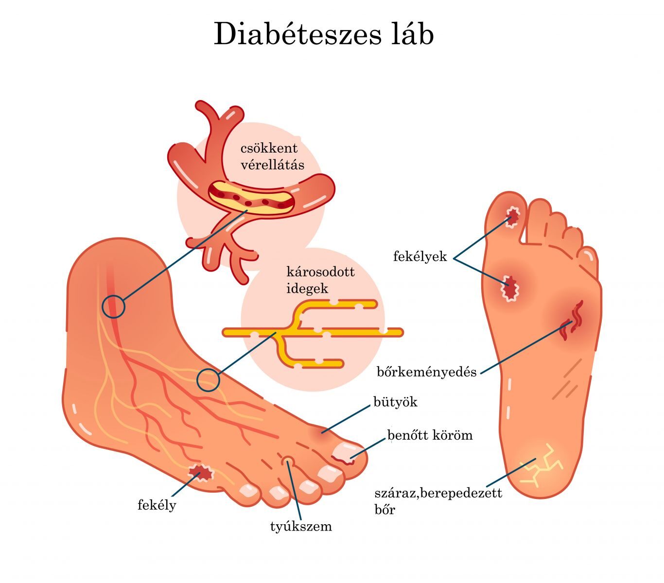 a kezelés a lábak a fekélyek diabetes