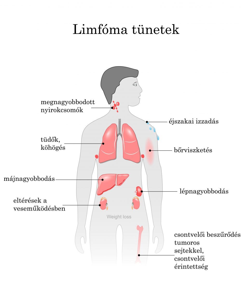 Limfóma | Magyar Rákellenes Liga, Limfóma tünetei nincs fogyás