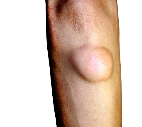 Lipoma eltávolítása