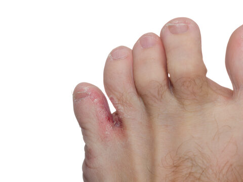 ödéma a lábujjak artritiszével
