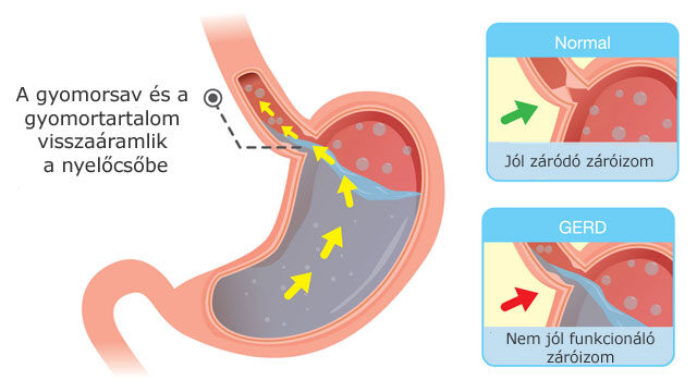 A záróizom működése és a reflux