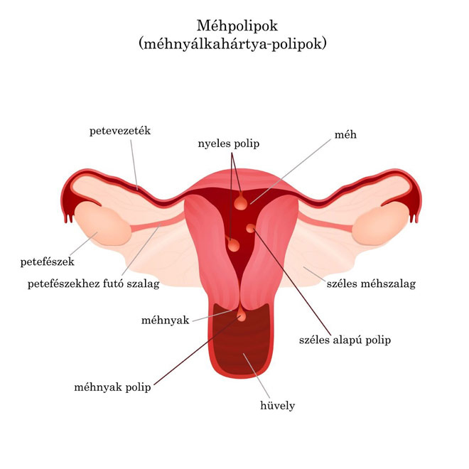 endometrium rák hiszteroszkópia