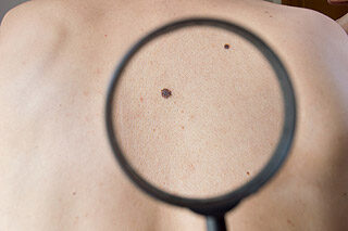 hová menjen a melanoma gyanúja esetén meggyógyított korral járó hyperopia