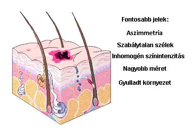 Melanoma - Önvizsgálat esetén fontos szempontok