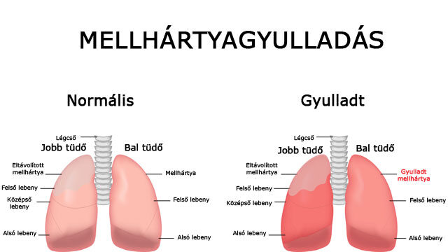 Mellhártyagyulladás