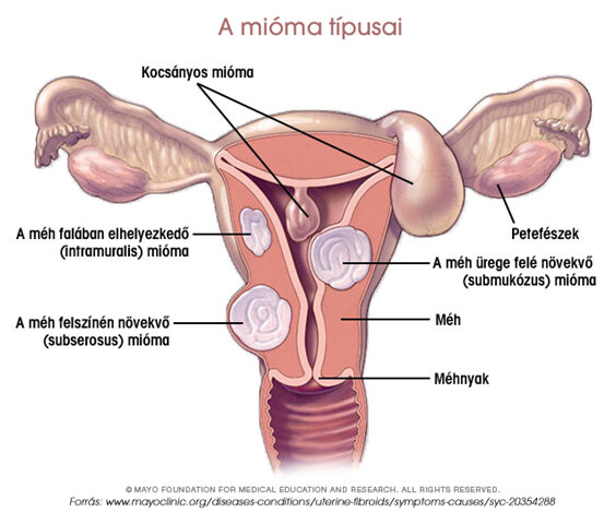 Méhmióma