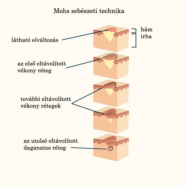 Mohs sebészeti technika