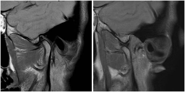 MR-felvétel az állkapocsízületről; Kép forrása: Diagnostica CT és MR központ