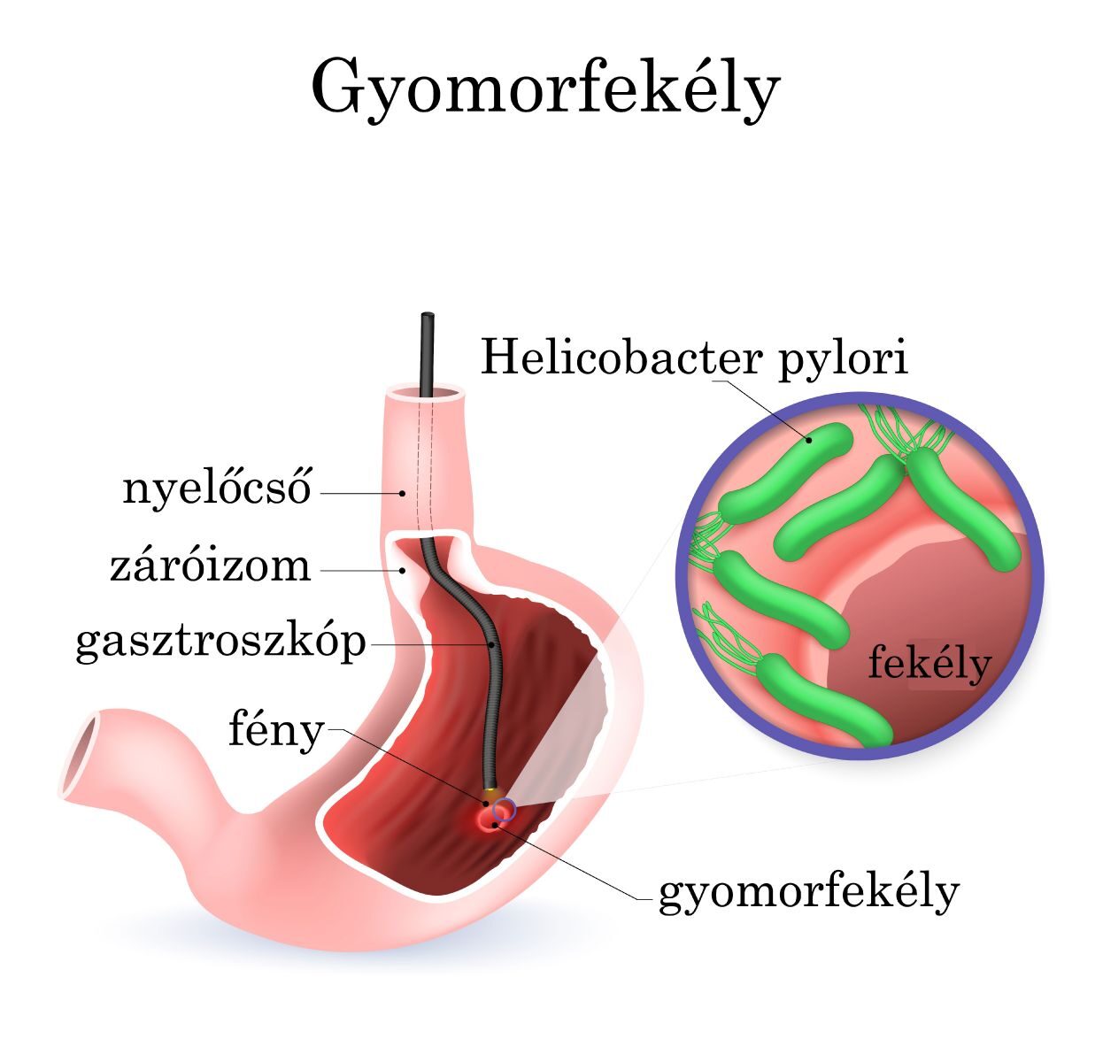 Gyomorfekély