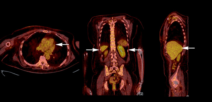 PET-CT-felvétel