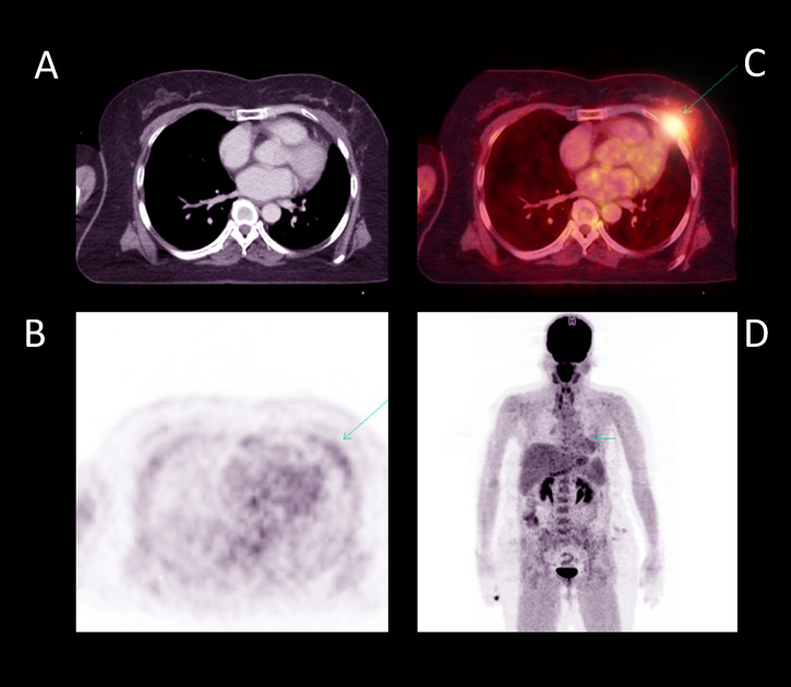 Egy tüdődaganatos beteg PET-CT-vizsgálata, akinél a tumor a mellkasfalon újult ki