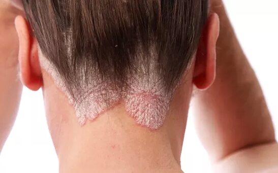 Pikkelysömör (pszoriázis, psoriasis) tünetei és kezelése - HáziPatika