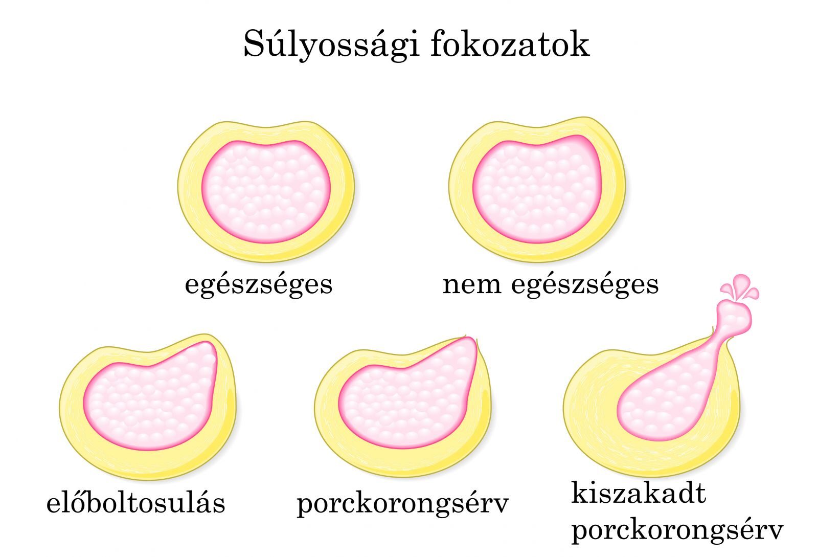 ízületi gyulladás és csigolya-sérv és kezelésük)