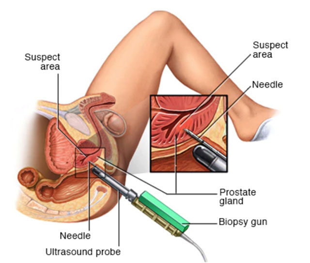 Prosztatabiopszia