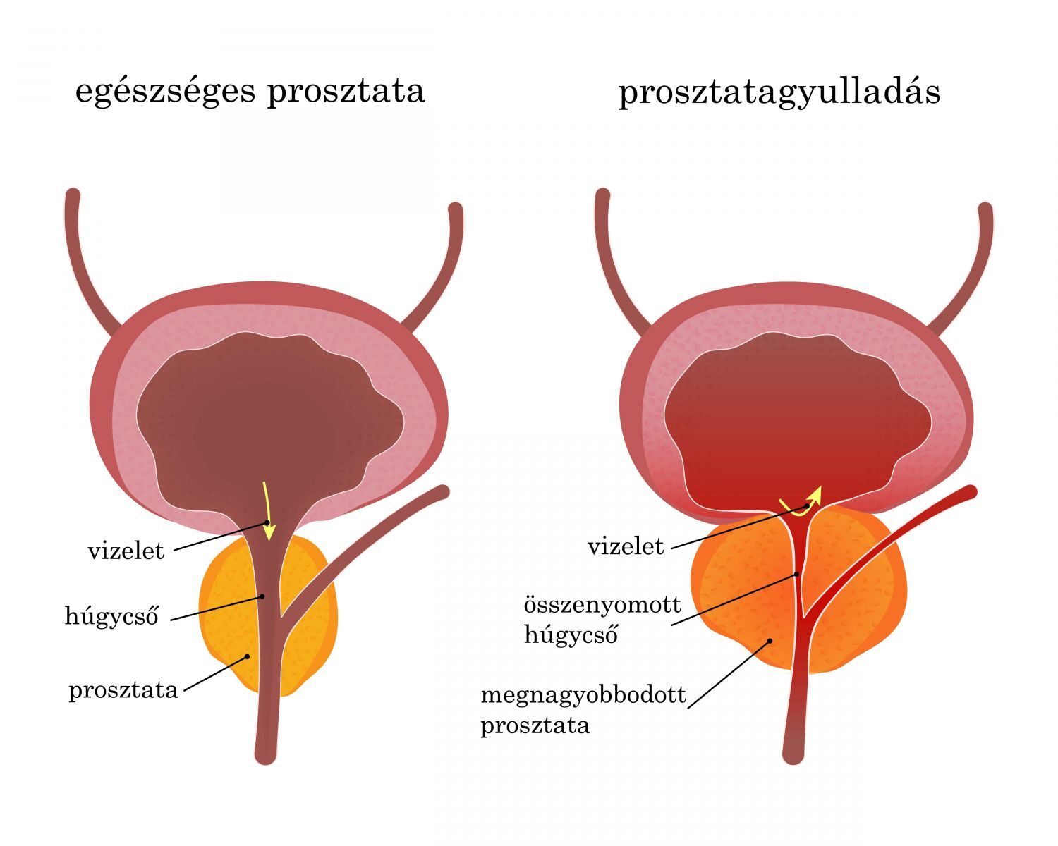 Kezelés és táplálkozás prosztatitis