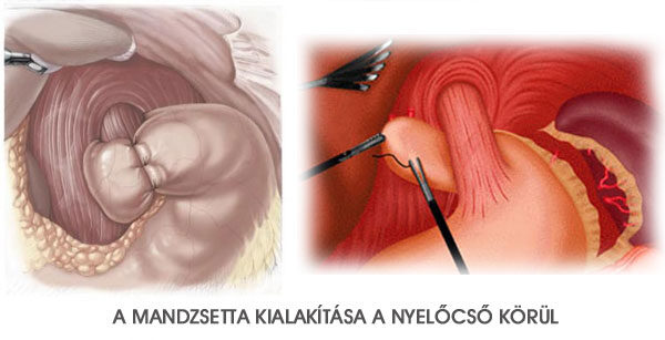 a vakbélműtét után nehéz fogyni hogyan égeti a test a zsírt természetesen