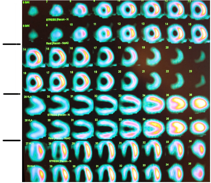 Szívizom izotópfelvételének eloszlásá SPECT-felvételsorozaton