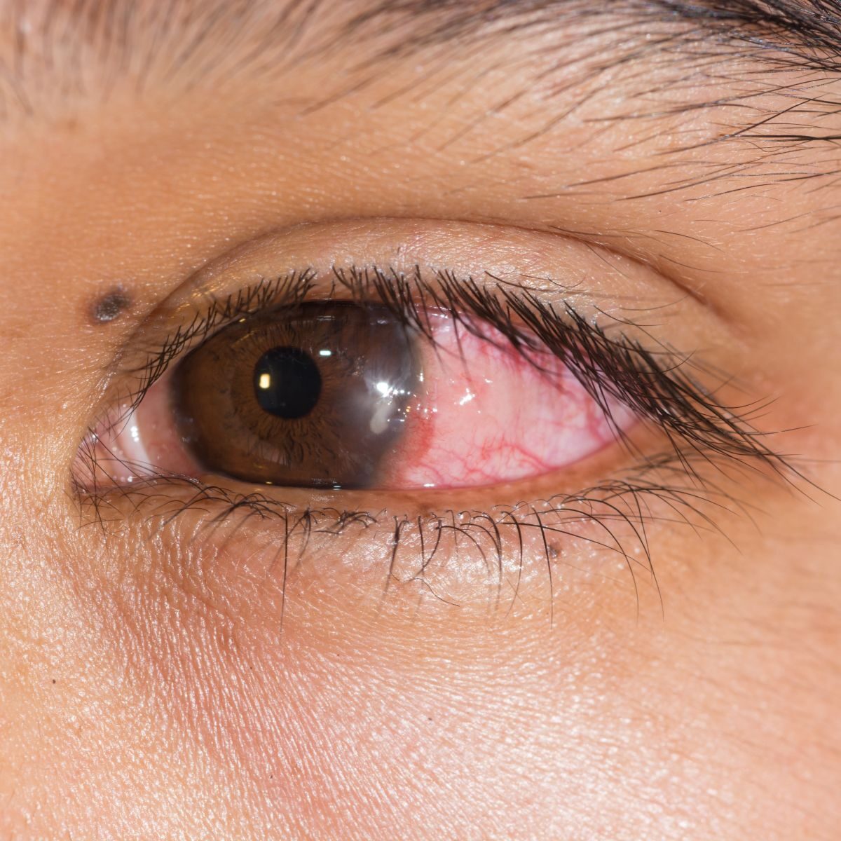 látás keratitis